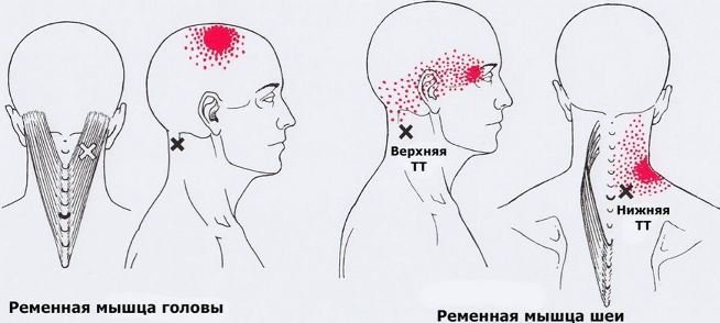 Триггерные точки на лице фото