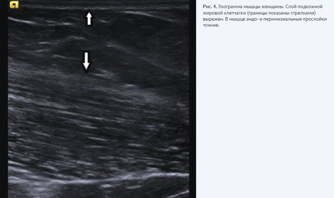 Узи мягких тканей живота что показывает. УЗИ мышц протокол. УЗИ мягких тканей ягодицы. Рубец мягких тканей на УЗИ. УЗИ мягких тканей голени.